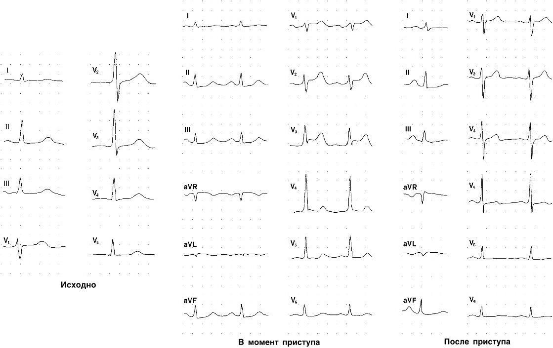 Элевация сегмента st что это. Элевации сегмента St на ЭКГ Тэла. Изменения на ЭКГ У больных туберкулезом.. Элевация сегмента St в AVR. ЭКГ внутренние болезни.