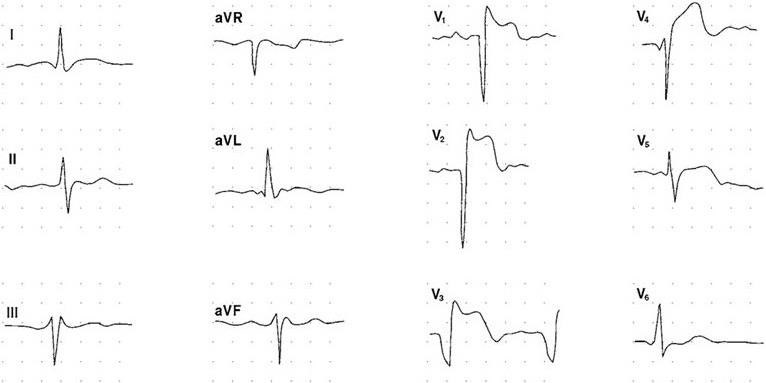 Подъем st в avf. Подъем сегмента St в AVR на ЭКГ. AVR на ЭКГ при инфаркте. Подъем сегмента St на ЭКГ v1-v6. Подъем St в AVR на ЭКГ.