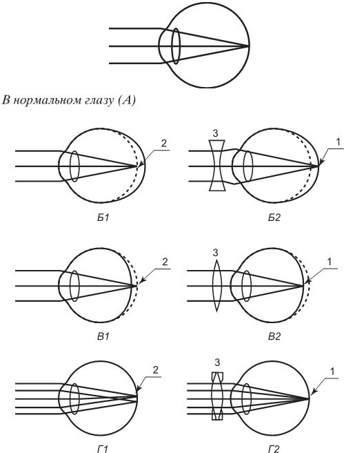 Какая из схем хода лучей в глазу человека соответствует случаю дальнозоркости глаза без очков