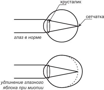 Если изображение фокусируется перед сетчаткой глаза возникает