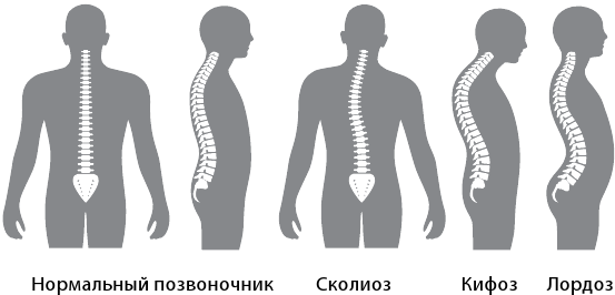 Лордоз кифоз сколиоз рисунок