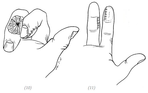 Ногтевая фаланга пальца. Пак Чже ву основы Су Джок терапии. Экзартикуляция пальца кисти. Кожная пластика пальцев. Пластика кожным лоскутом пальца.